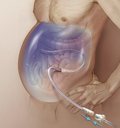 Medische interventie voor ascites