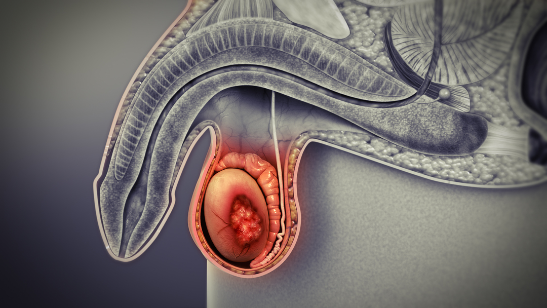 Testicular cancer in men: symptoms, causes, how to treat, prognosis
