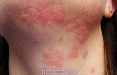 Behandlung von allergischen Hautausschlägen mit Folk-Mitteln