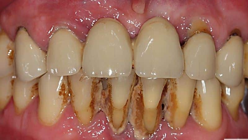 parodontitis behandling i hjemmet