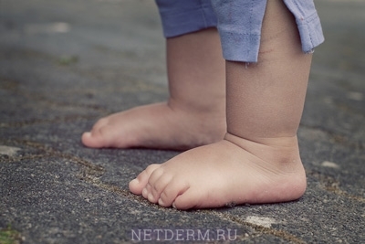 Eingeschränkte Neurodermitis bei Kindern
