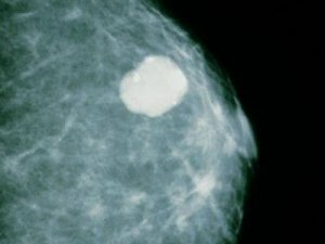Fibroadenoma of the breast