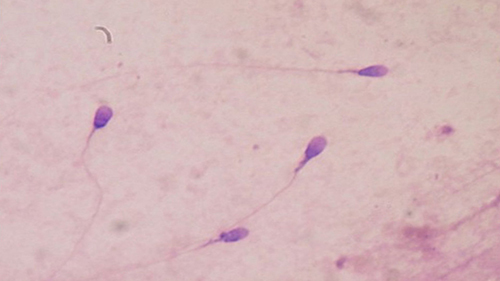 ¿Se trata la criptozoospermia( un pequeño número de espermatozoides)?