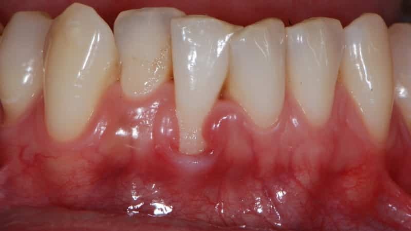 Zahnfleischschwund Behandlung zu Hause