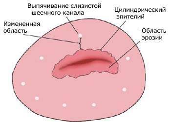315200-erosion-cervical uteri