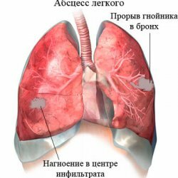 Ascesso polmonare