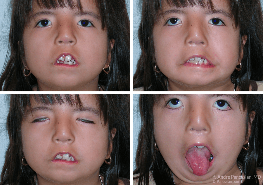 Moebius syndrome: what is it, symptoms (photo), treatment