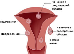Leiomyoma van de baarmoeder