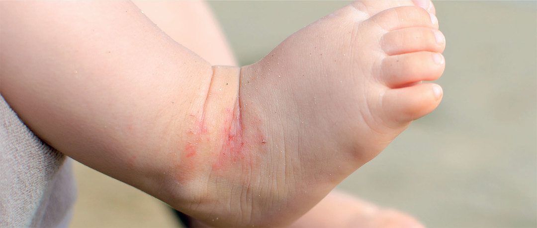 Neurodermatitis in adults and children: symptoms (photo), treatment