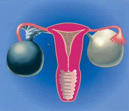 As-complicated-ovarian cysts