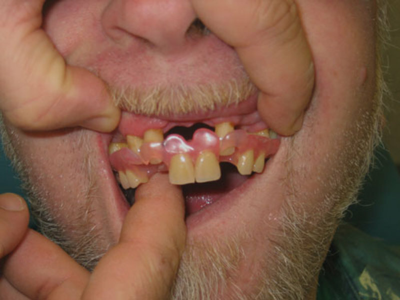 Jak nosit nylonové zubní protézu