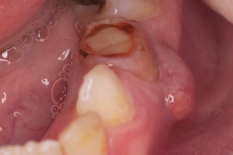 periodontite de dentes decíduos em crianças