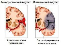 Masivni moždani udar - kako je to opasno?