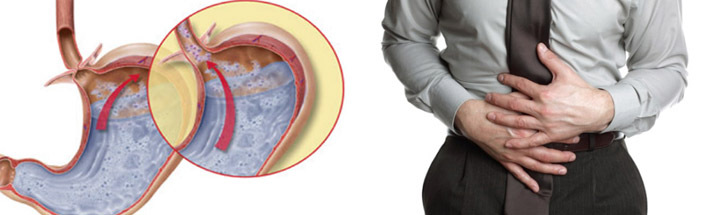 Erkrankung der Gallenreflux-Gastritis