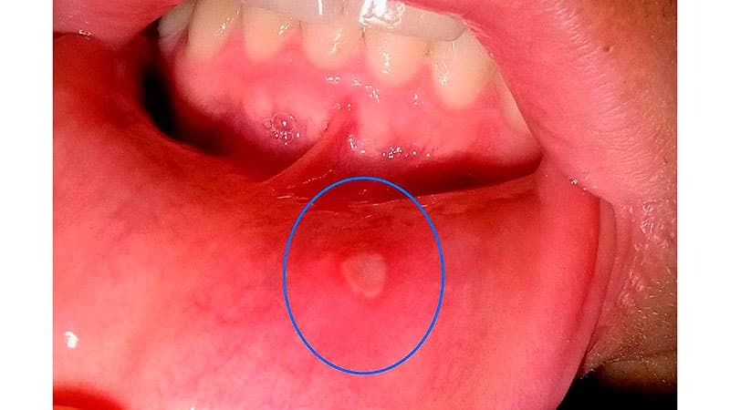 Di mulut, ada sakit putih: bagaimana memperlakukan