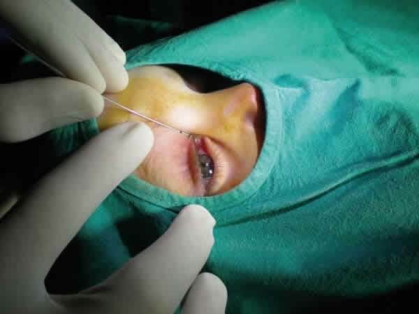 Chirurgische behandeling van traankanaal obstructie