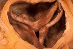 Aorta stenosis