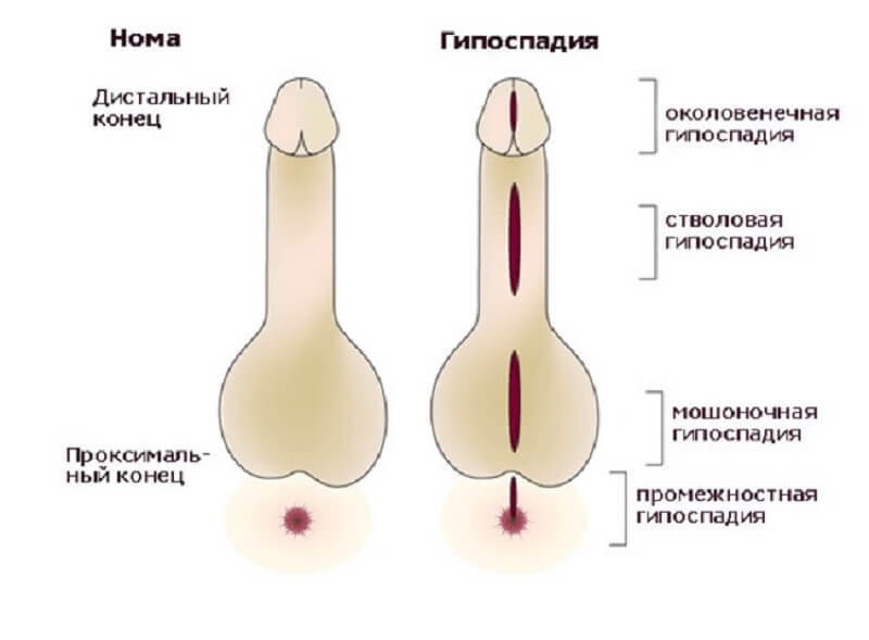 Stamvorm van hypospadie en kenmerken van de behandeling ervan
