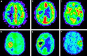 Hipoxia cerebral