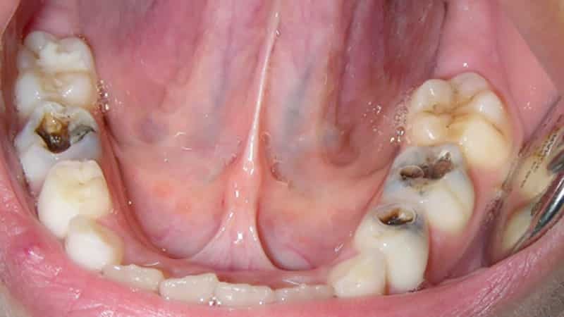 Pulpitis primarni zob pri otrocih: obdelava in odstranitev živca