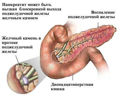 kronični pankreatitis