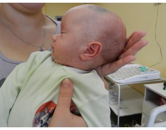 liječenje moždanog edema kod novorođenčadi