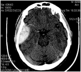 Cerebralna tomografija