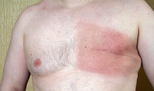 Breast removal in men