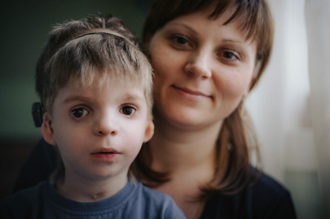 Treacher-Collinsi sündroom: mis see on, sümptomid, ravi, prognoos