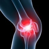 Methoden voor de behandeling van artrose van kniegewrichten