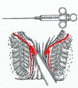 Esclerosis de hemorroides