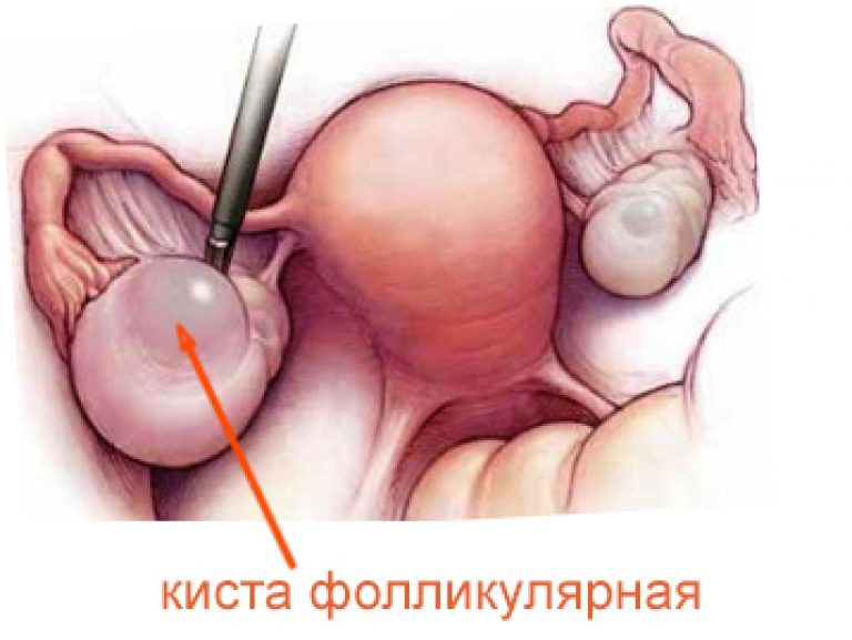 Cyste op de eierstok: behandeling en van wat het leek bij een vrouw