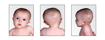 neurogenní tortikolis-u-1 novorozenec