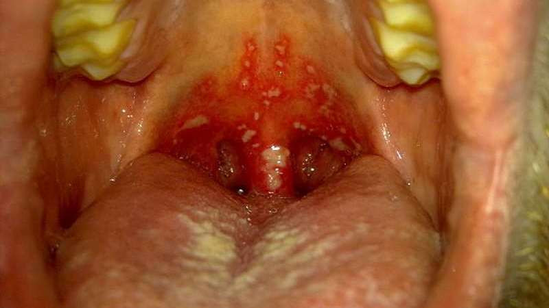 stomatitis zdravljenje tonzilarnega