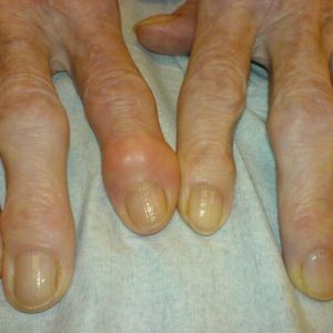 Arthritis of the joints of the fingers