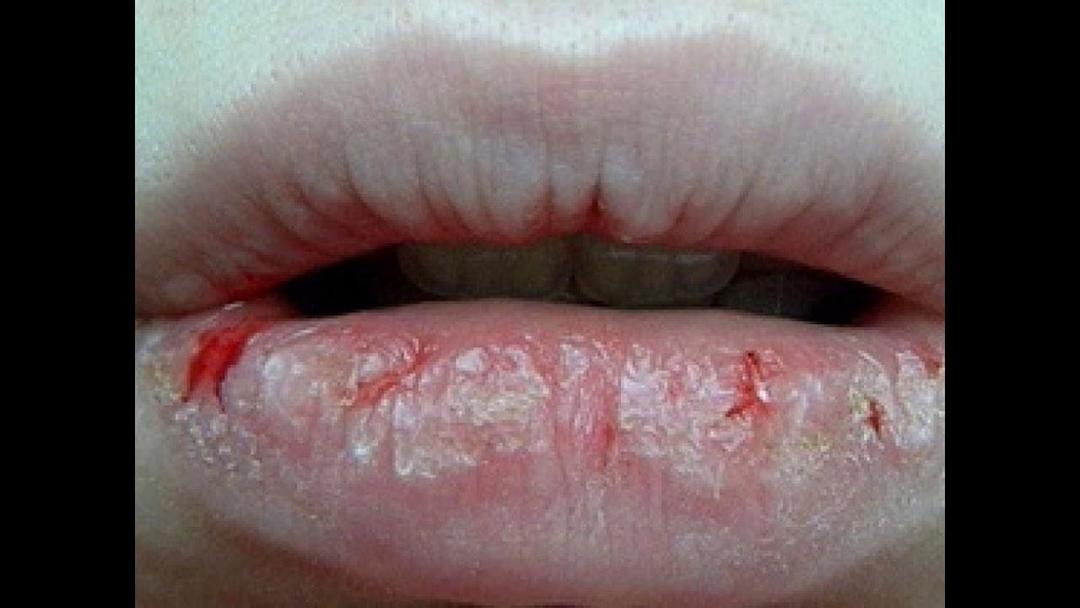 Kulit dan bibir kering adalah tanda dehidrasi selama keracunan tubuh