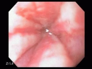 Reflux-oesofagitis