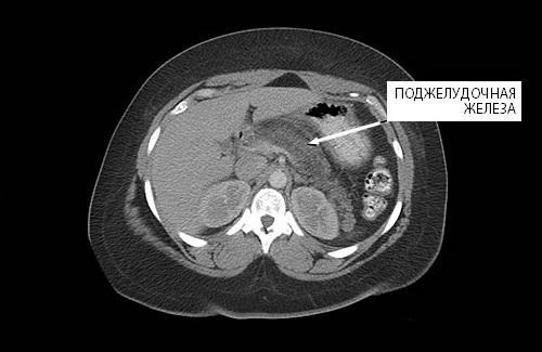 MRI scan of the pancreas