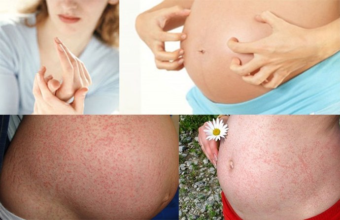 Alergias durante a gravidez: como tratar, pílulas, efeitos no feto