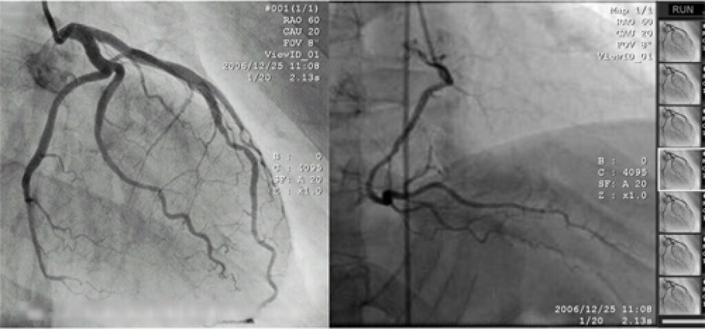 operasi bypass arteri koroner: indikasi untuk dan periode pasca operasi