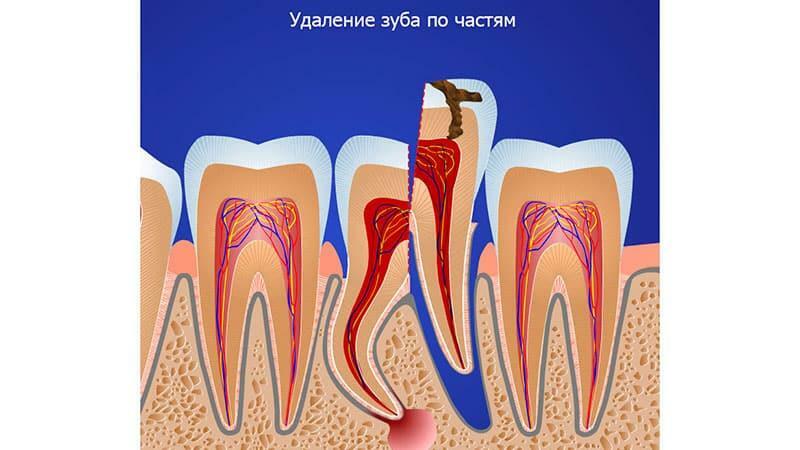 Uklanjanje korijen zuba