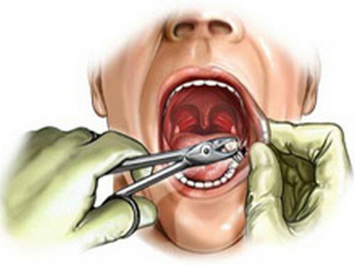 Features of wisdom tooth extraction