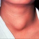 Case Report: Thyroid Cancer