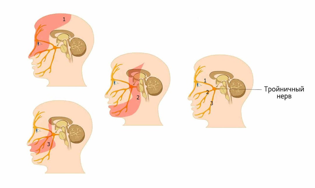 Trīszaru nerva neiralģija: simptomi un ārstēšana