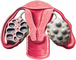 Multifollular ovaries