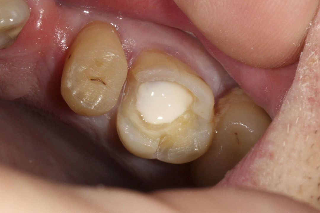 Soorten tandvulling - wat te kiezen?