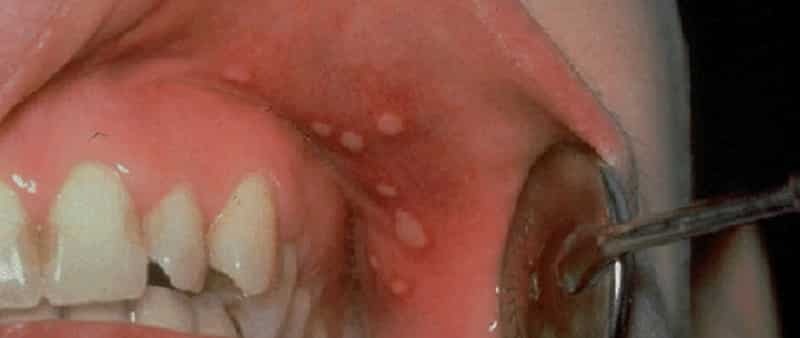przezroczysty wodnisty pęcherzyk błony śluzowej jamy ustnej w