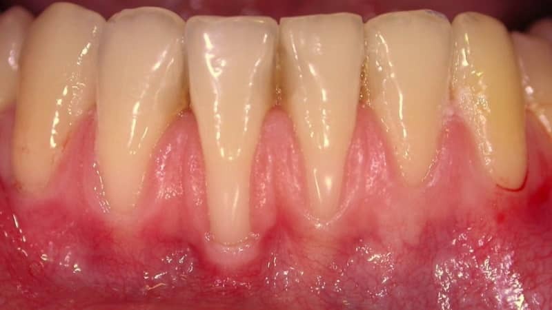 tænder tandkød er kløe for en voksen, hvorfor hvad de skal gøre