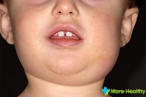 Mumps disease: the danger for men