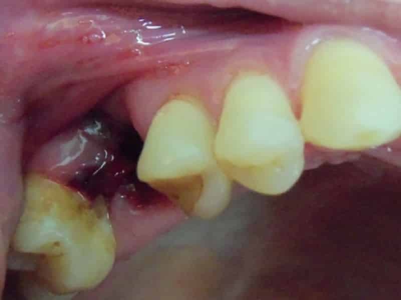 Pus after the removal of the wisdom tooth: why appears, how to avoid